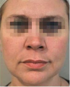 Profhilo Before & After Gallery | Face