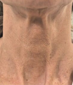 Profhilo Before & After Gallery | Neck