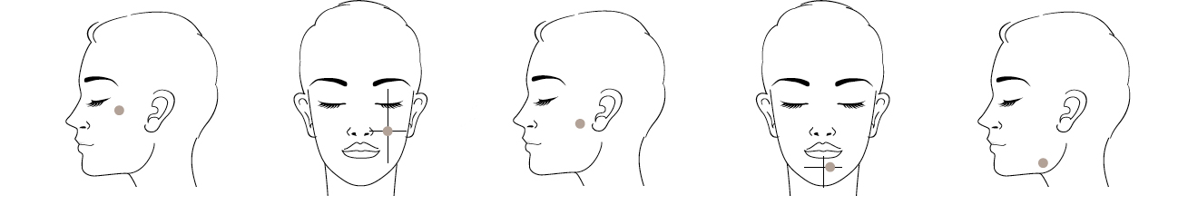 Injectables hyaluronic acid technique